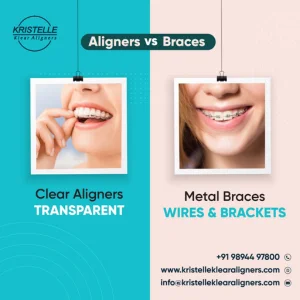 Top Digital Marketing With Clear Aligners in Coimbatore